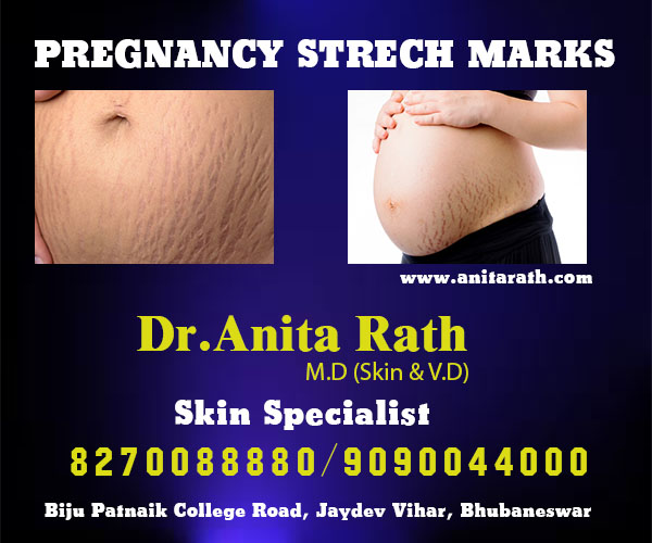 Pregnancy stretch mark treatment clinic in Bhubaneswar, odisha
